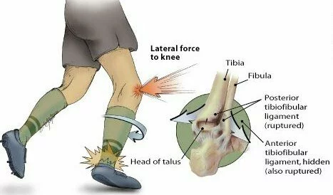 high ankle sprain cause